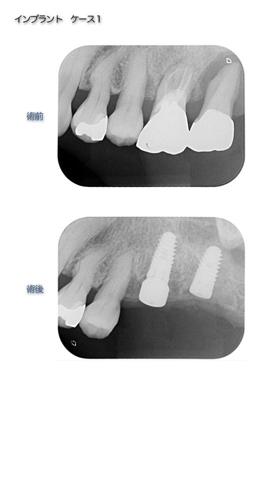 インプラントケース1