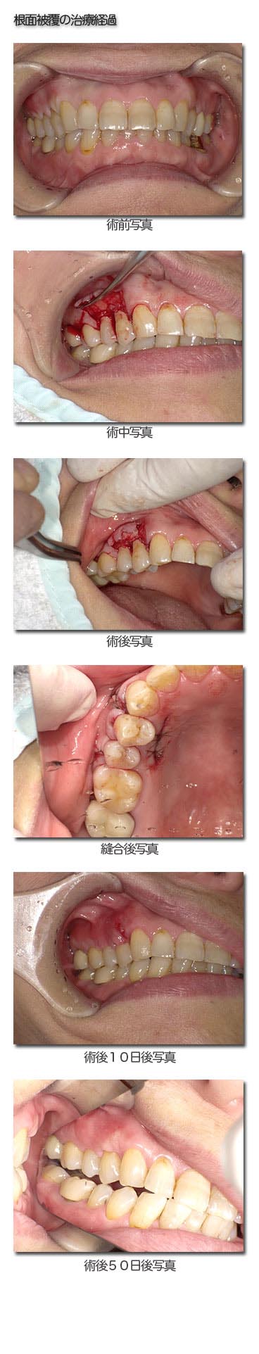 根面被覆の治療経過