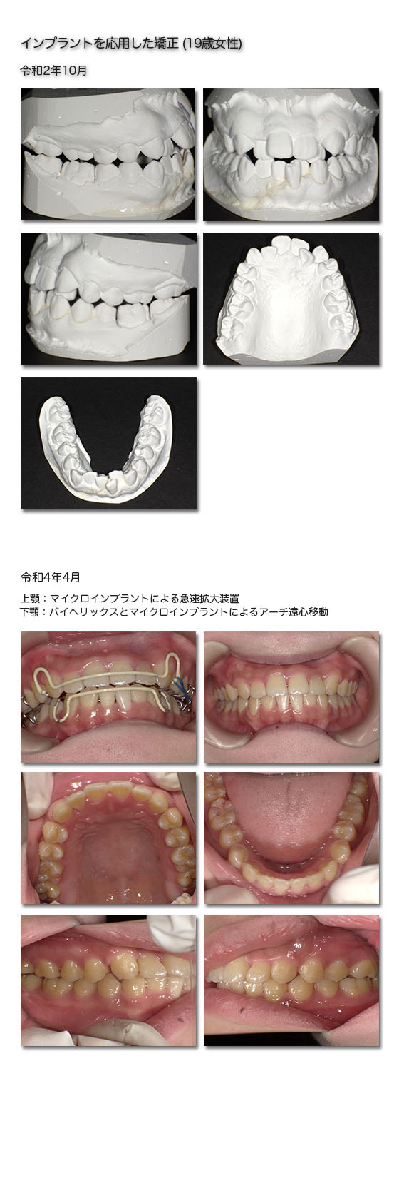 インプラント応用矯正